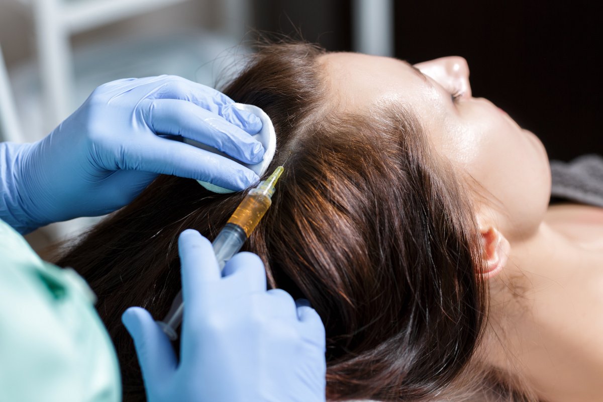 Mezoterapia skóry głowy - sposób na wypadanie włosów