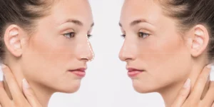 Zabieg plastyki nosa w klinice Re Vitae