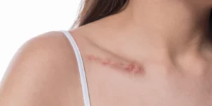 Zabieg laserem frakcyjnym na blizny w klinice Re Vitae