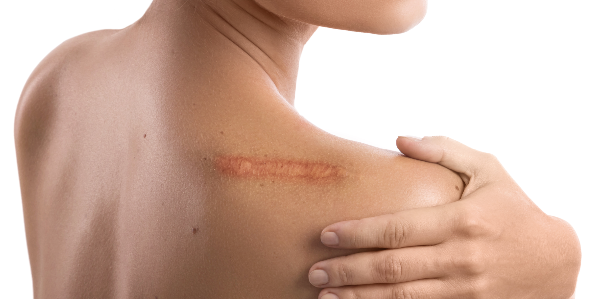 Zabieg ostrzyknięcia blizny sterydem w klinice Re Vitae