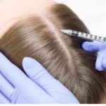 Terapia wypadania włosów: Polinukleotydy na skórę głowy