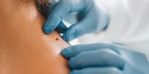 Laserowe usuwanie zmian skórnych w klinice Re Vitae