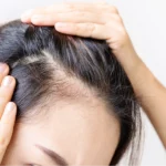 Terapia wypadania włosów: Egzosomy z mezoterapią mikroigłową Dermapen