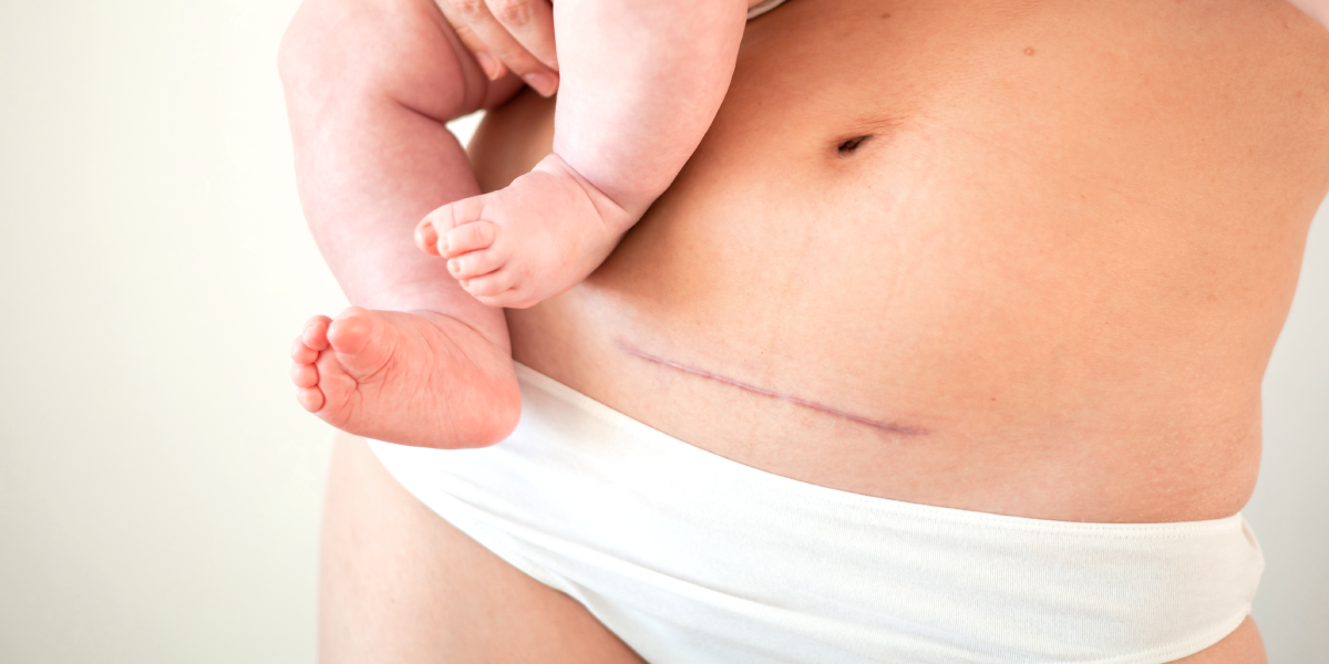 Laserowa korekcja blizn w klinice Re Vitae Kielce