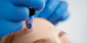 Mezoterapia mikroigłowa Dermapen twarzy w klinice Re Vitae Kielce