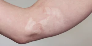 Laser tulowy w leczeniu blizn w klinice Re Vitae Kielce