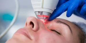 Laser tulowy na twarz w klinice Re Vitae Kielce