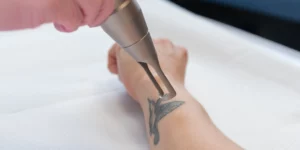 Laserowe usuwanie tatuażu w klinice Re Vitae Kielce