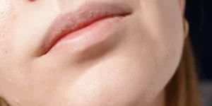 Zabieg IPL na brodę w leczeniu rumienia i trądziku różowatego w klinice Re Vitae Kielce