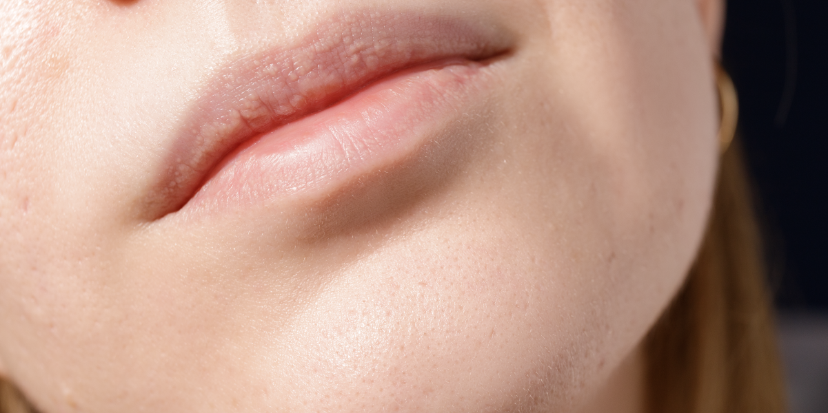 Zabieg IPL na brodę w leczeniu rumienia i trądziku różowatego w klinice Re Vitae Kielce