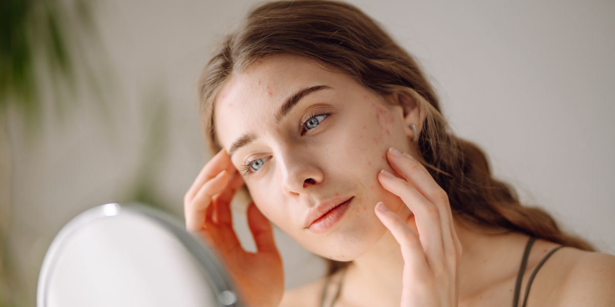 Zabieg IPL na czoło w leczeniu rumienia i trądziku różowatego w klinice Re Vitae Kielce