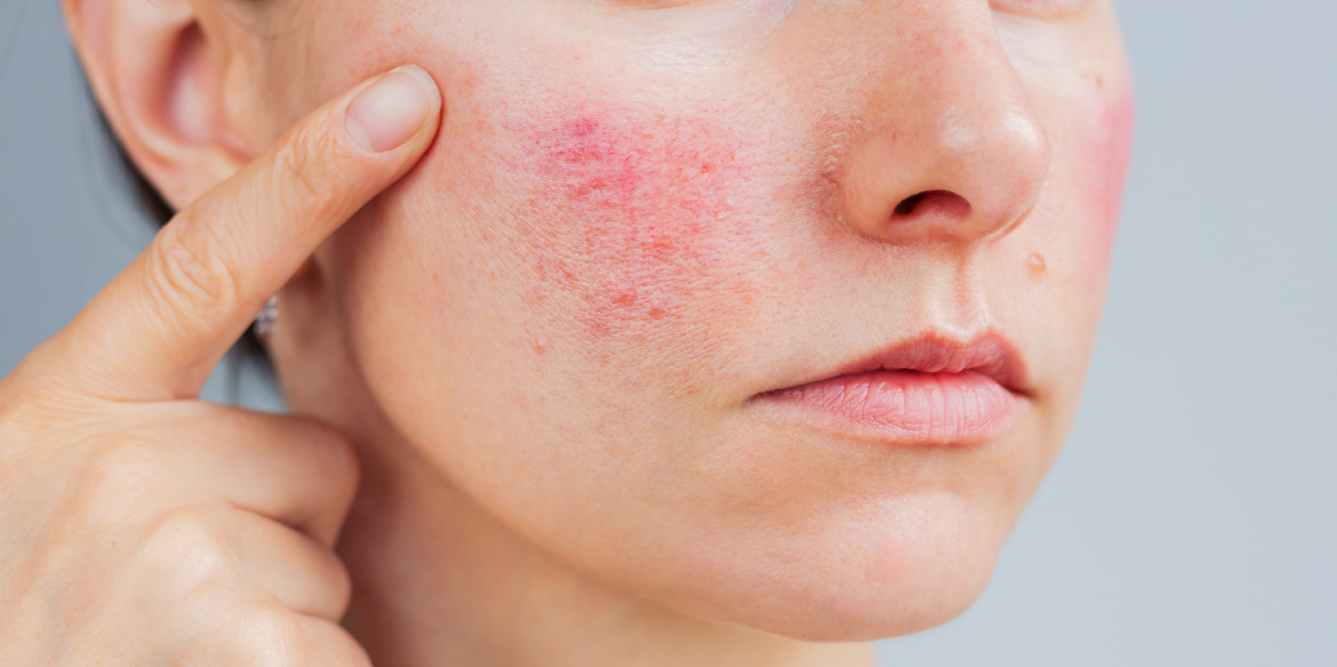 Zabieg IPL na twarz w leczeniu rumienia i trądziku różowatego w klinice Re Vitae Kielce