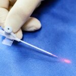 EVLT (wewnątrznaczyniowe laserowe zamykanie żylaków)