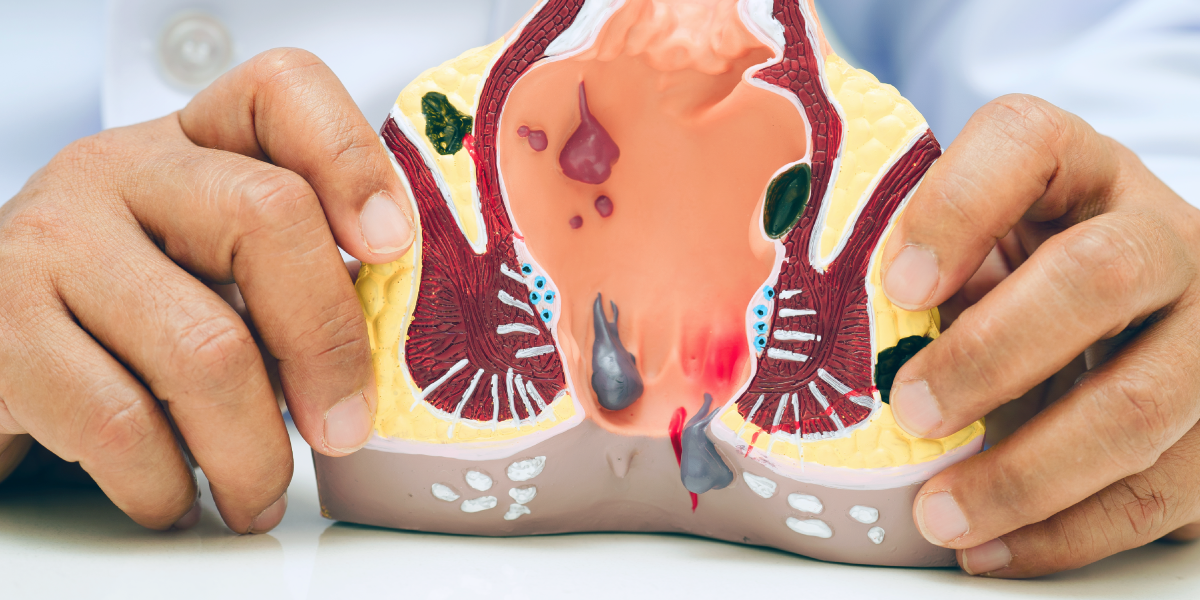 Leczenie przetoki odbytu w klinice Re Vitae Kielce