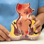 Laserowe leczenie przetoki odbytu