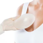 Plastyka piersi - wymiana implantów z usunięciem torebki