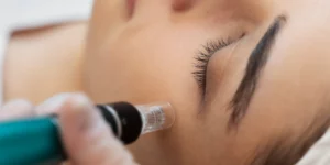 Mezoterapia igłowa Jalupro Young Eye – regeneracja i odmłodzenie skóry wokół oczu.