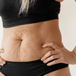 Laserowe usunięcie fałdów skórnych