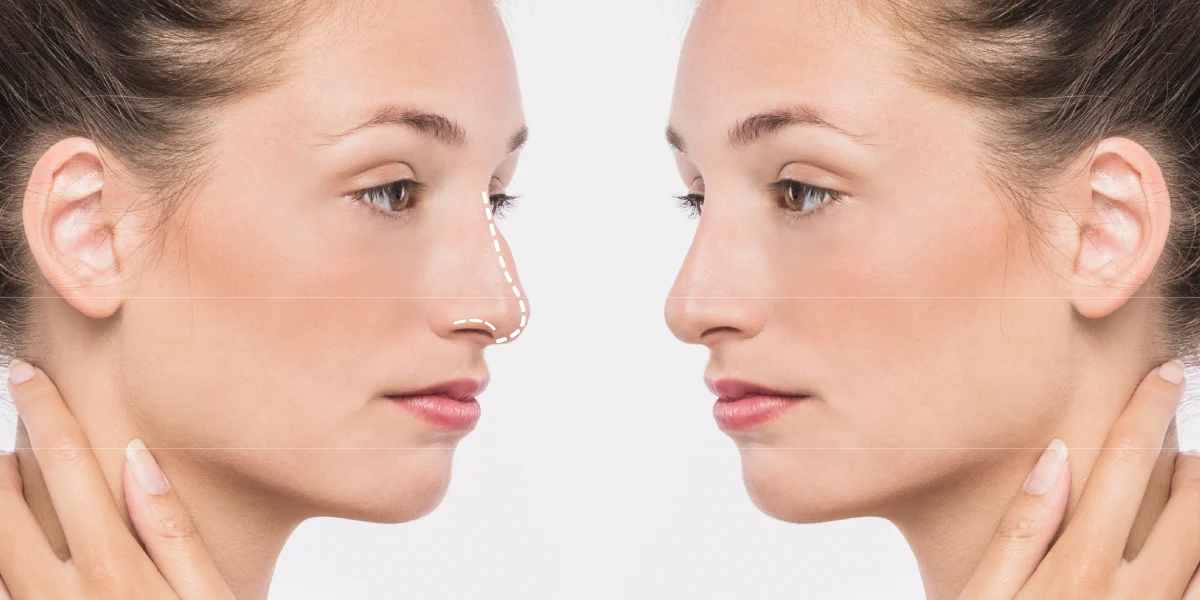 Zabieg plastyki nosa w klinice Re Vitae