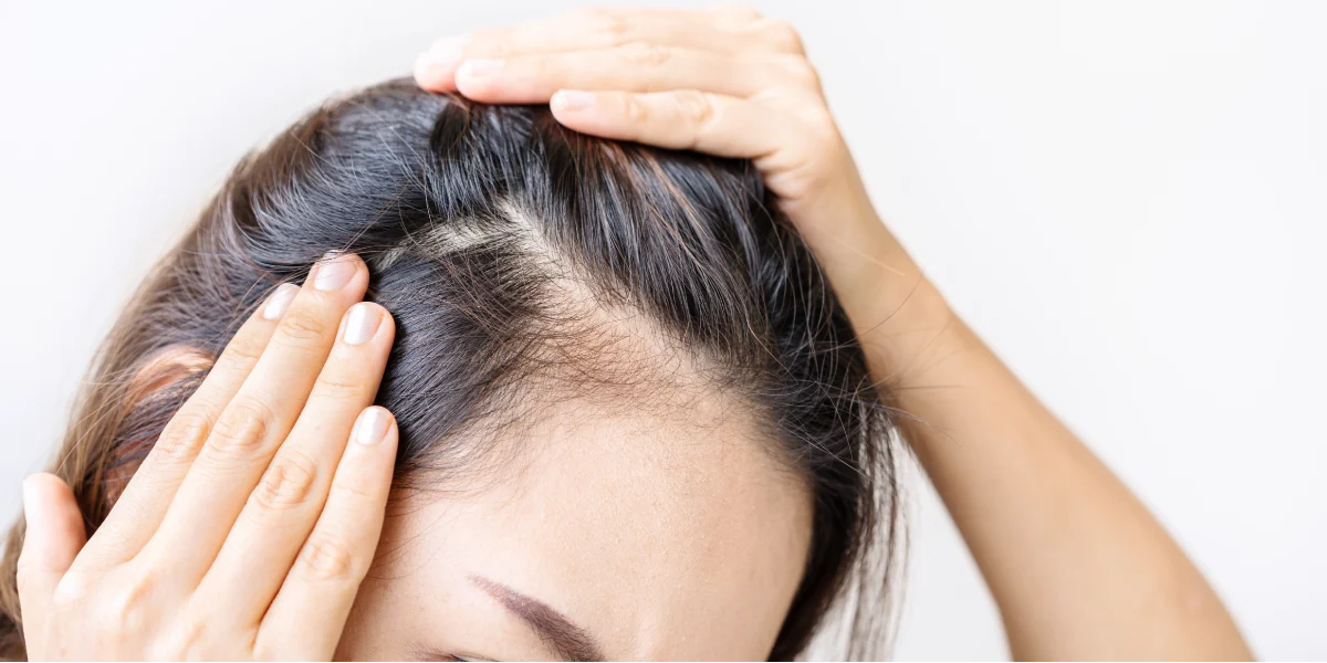 Terapia leczenia wypadania włosów w klinice Re Vitae