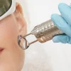 Laseroterapia CO₂ frakcyjna w klinice Re Vitae Kielce