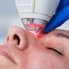 Laser tulowy na twarz w klinice Re Vitae Kielce