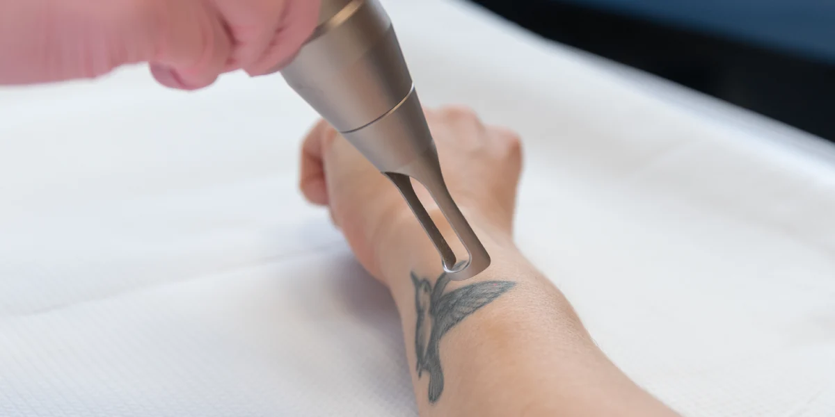 Laserowe usuwanie tatuażu w klinice Re Vitae Kielce