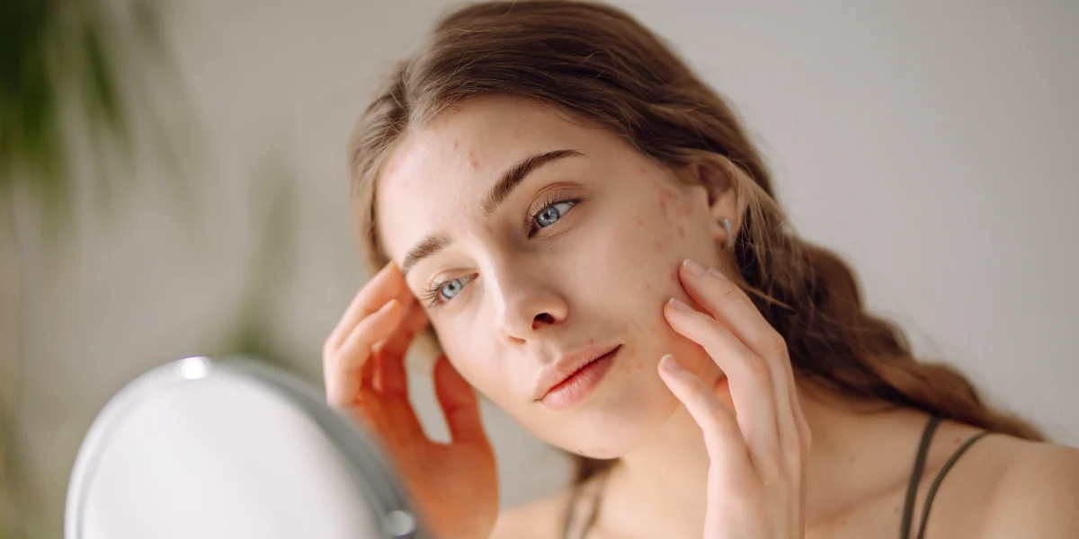 Zabieg IPL na czoło w leczeniu rumienia i trądziku różowatego w klinice Re Vitae Kielce