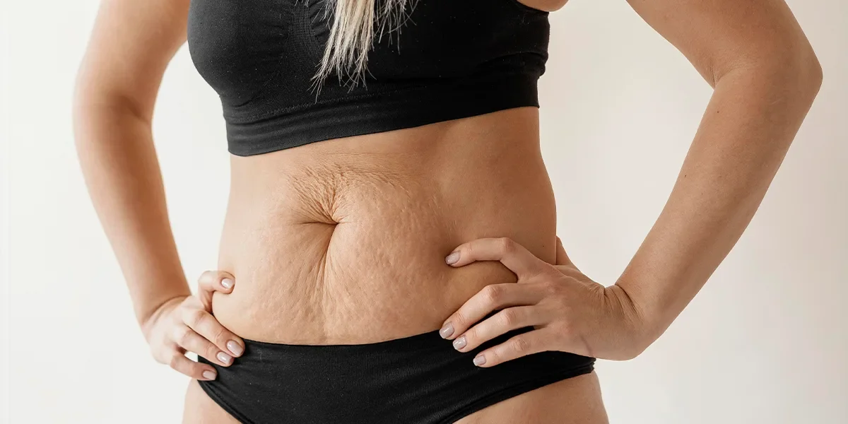 Laserowe usunięcie fałdów skórnych