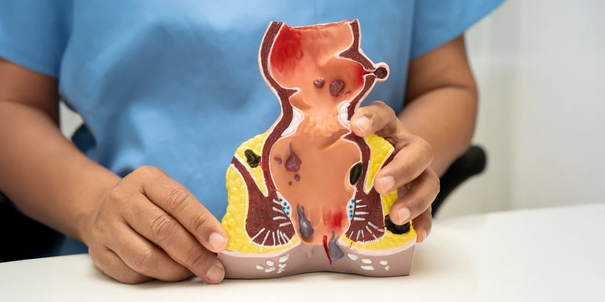 Laserowe leczenie przetoki odbytu w klinice Re Vitae Kielce