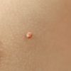 Concept of body care with skin with papilloma or mole