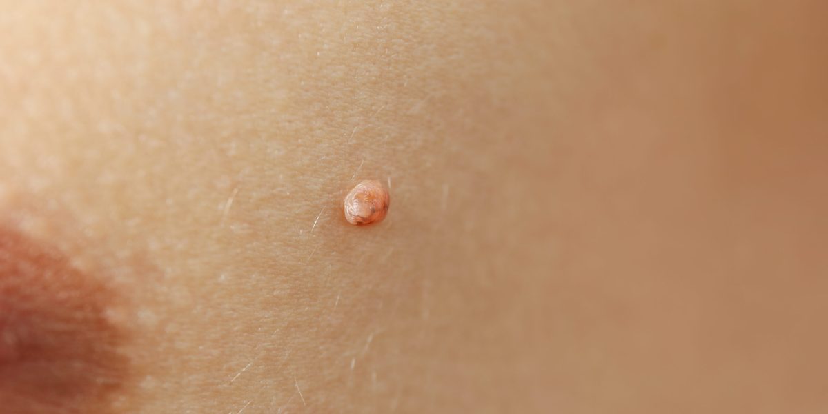 Concept of body care with skin with papilloma or mole