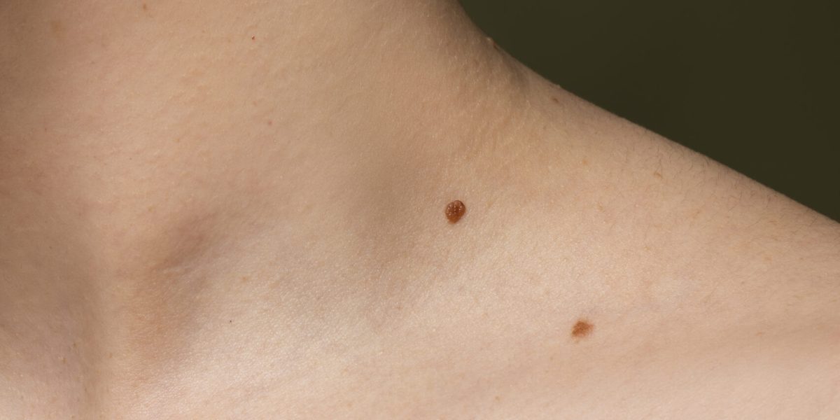 side-view-skin-texture-with-moles-scaled-1